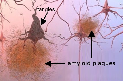 Amyloid Plaques