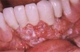 Рак поласці рота
